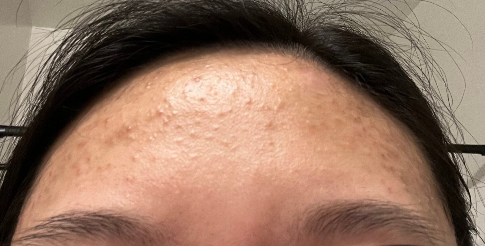 My Fungal Acne Journey: What Finally Helped Clear My Skin